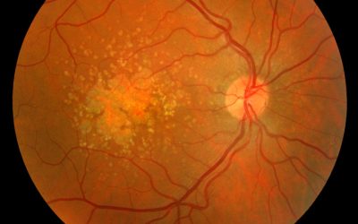 Studies: Consuming alcohol increases macular degeneration risk while fruit and veggie consumption lowers risk